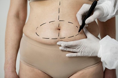Mujer realizándose abdominoplastia en medellin