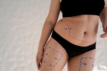 Mujer antes de realizarse una lipotransferencia en Medellín