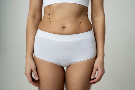 Mujer antes de realizarse una lipotransferencia en Medellín