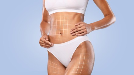 Mujer despúes de realizarse una lipotransferencia en Medellín