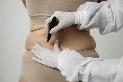 Liposucción en clínicas estéticas en Medellín