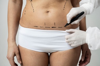 Abdominoplastia en clínicas estéticas en Medellín