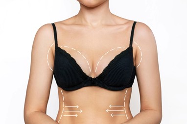 Diferencia entre mamoplastia, mastopexia y reducción mamaria